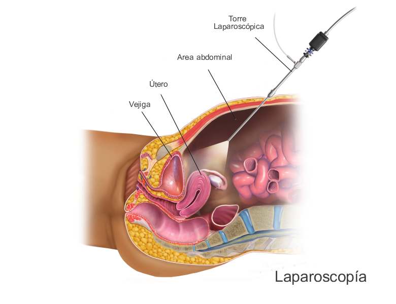 laparoscopia-cnicrea